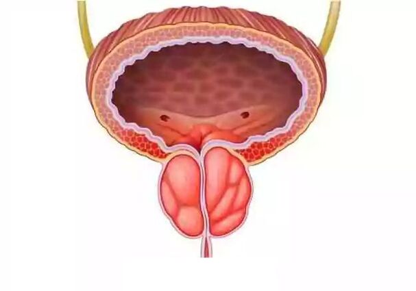 Treatment of prostatitis in men