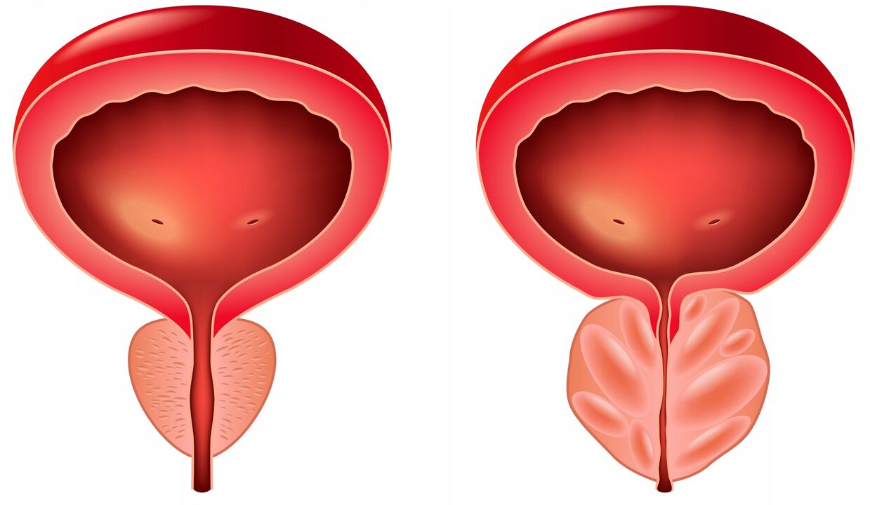 the difference between the prostate glands